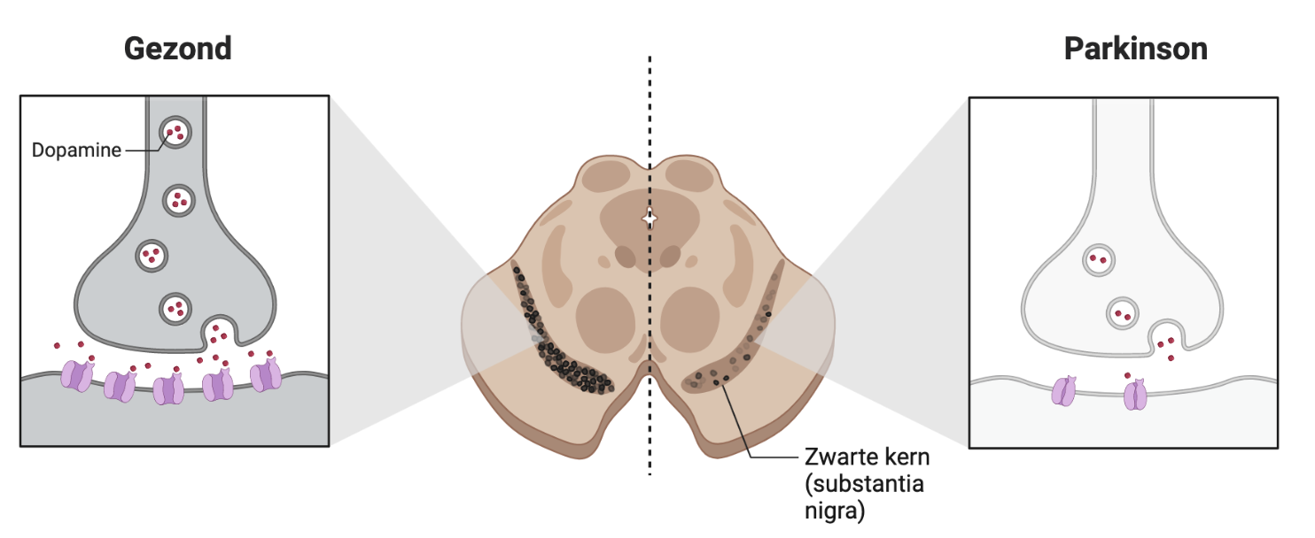Dopamine verlies bij de ziekte van Parkinson
